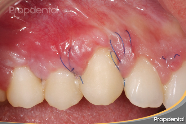 sutura del injerto del paladar en regeneración tisular guiada