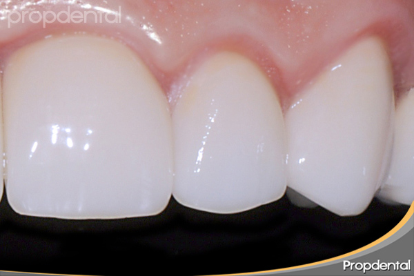 tipos de porcelana dental