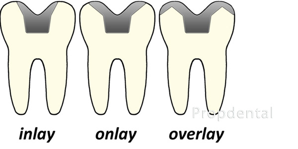 tipos incrustaciones dentales inlay onlay overlay