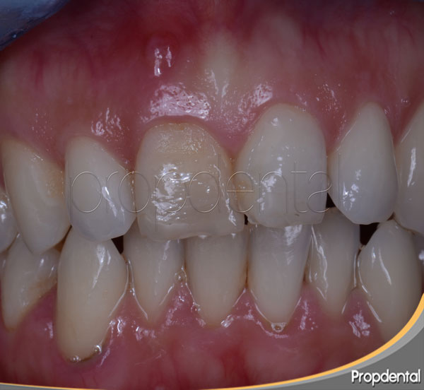 tratamiento absceso dental