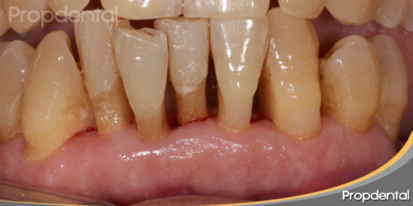 tratamiento periodontitis avanzada