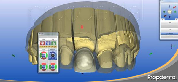 zirconio diseñado con cad cam dental