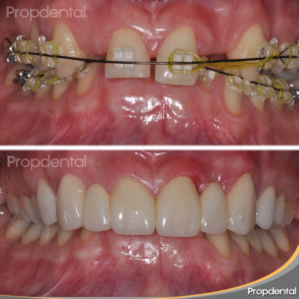 caso clínico coronas dentales
