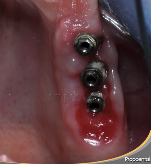 Diagnóstico de la periimplantitis