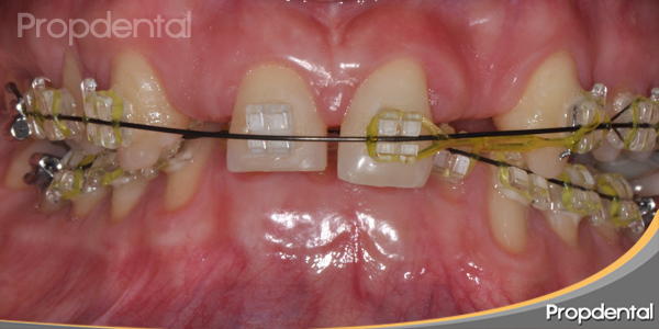 dientes con ortodoncia estética