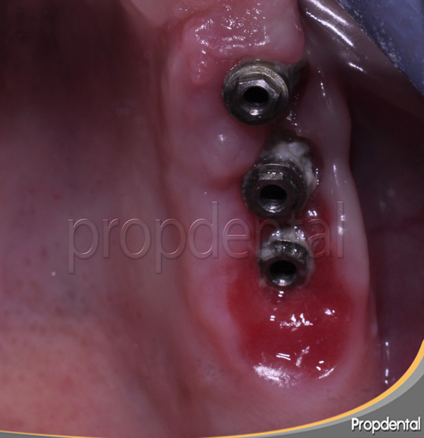 mucositis periimplantaria