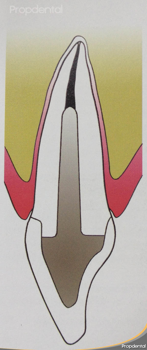 perno muñon