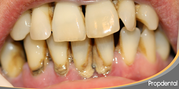 Periodontitis avanzada