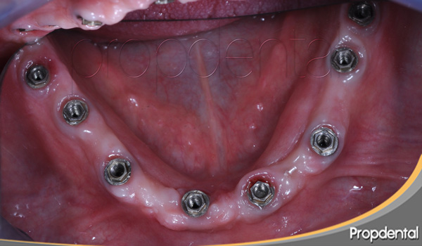 titanio de los implantes dentales