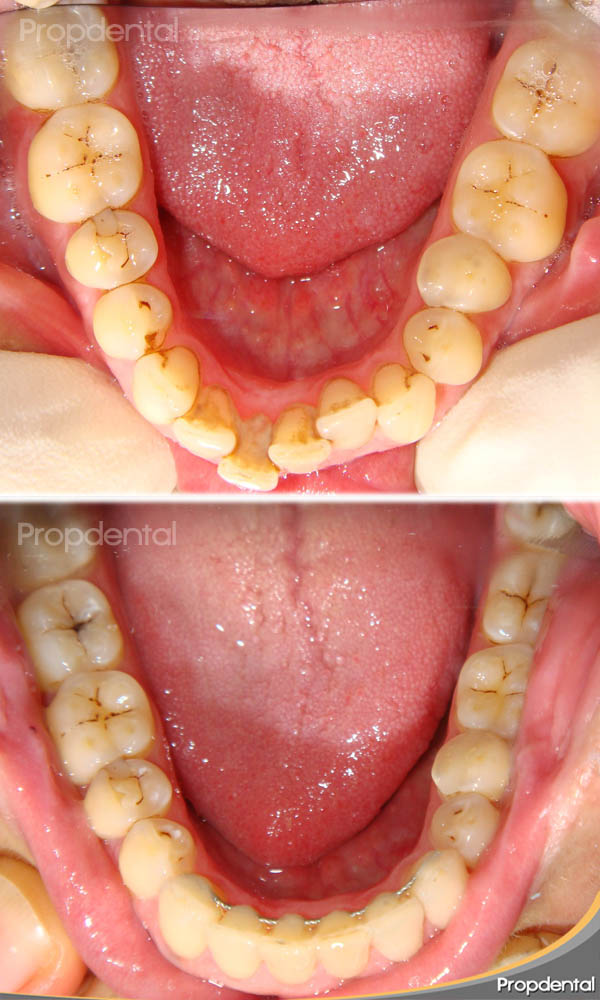 arcadas dentales estrechas tratadas con ortodoncia