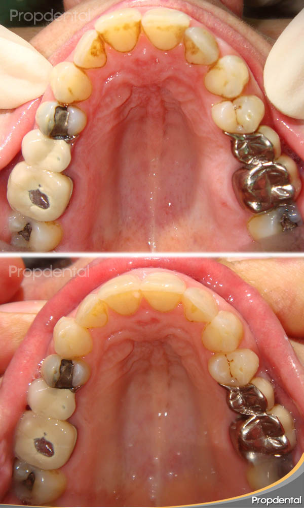 caso clínico de ortodoncia finalizado
