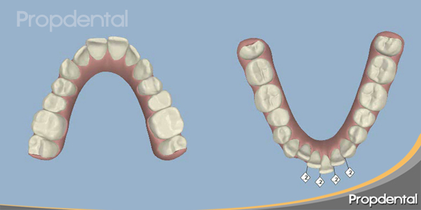 clinchek en donde empezamos la planificación de la resolución ortodoncica de la arcadas dentales estrechas