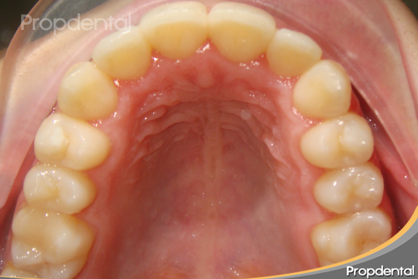 dientes alineados