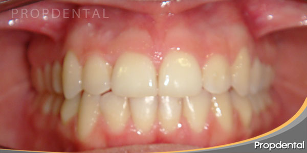 dientes corregidos con invisalign