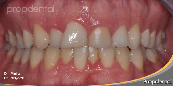 dientes incisivos