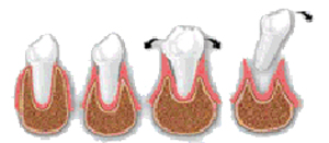 evolución  de la enfermedad periodontal del adulto