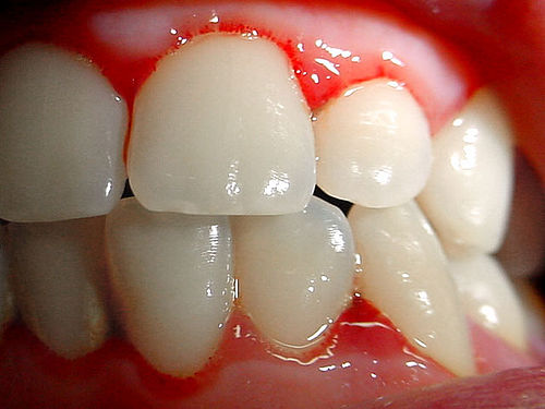 gingivitis ulceronecrotizante aguda