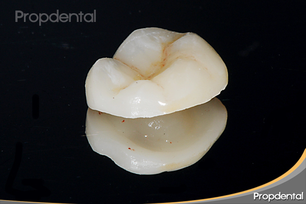 incrustacion dental tipo overlay