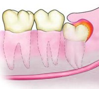 causas de la pericoronaritis