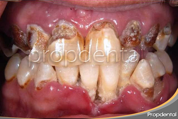 periodontitis avanzada