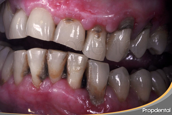 periodontitis crónica del adulto