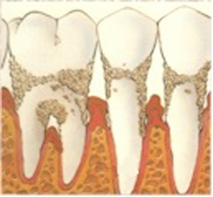 tipos de periodontitis