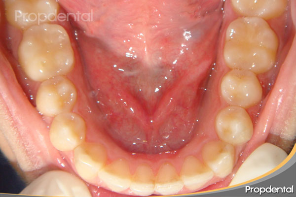 posición final de la ortodoncia invisible