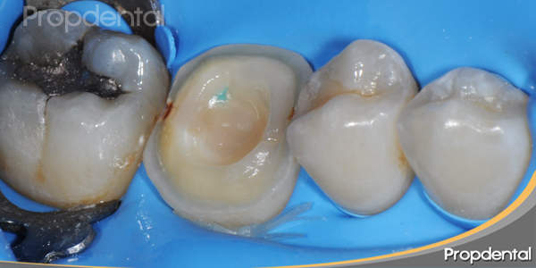 preparación diente endodonciado