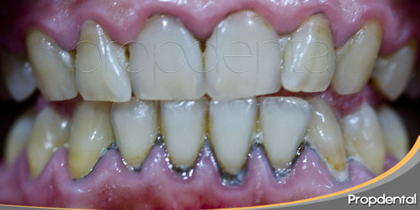 Prevención del sarro dental