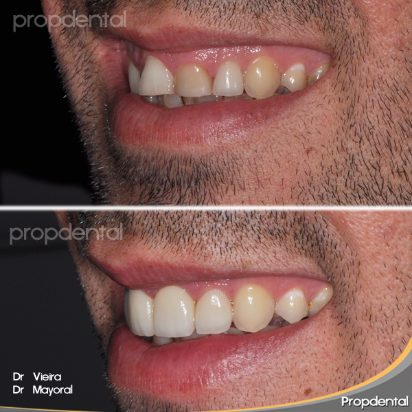 prótesis dentales en los incisivos superiores