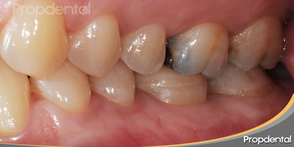 restauración después de la endodoncia