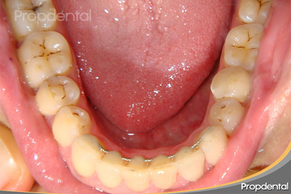 retención fija de ortodoncia