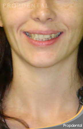 sonrisa antes del invisalign G4