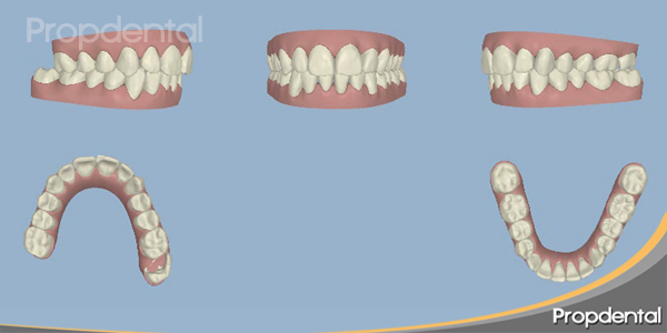 tratamiento ortodoncia invisible por ordenador