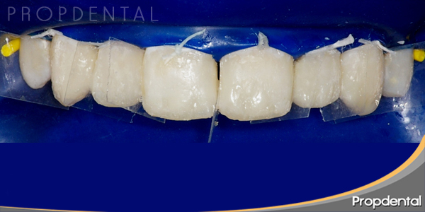 Cierre de diastema con composite