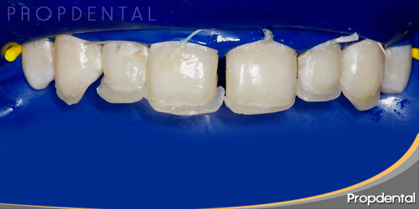 composite dental