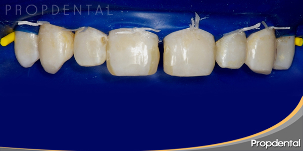 diastema cental interincisivo