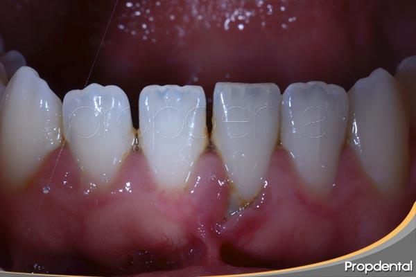 recesión gingival por sarro