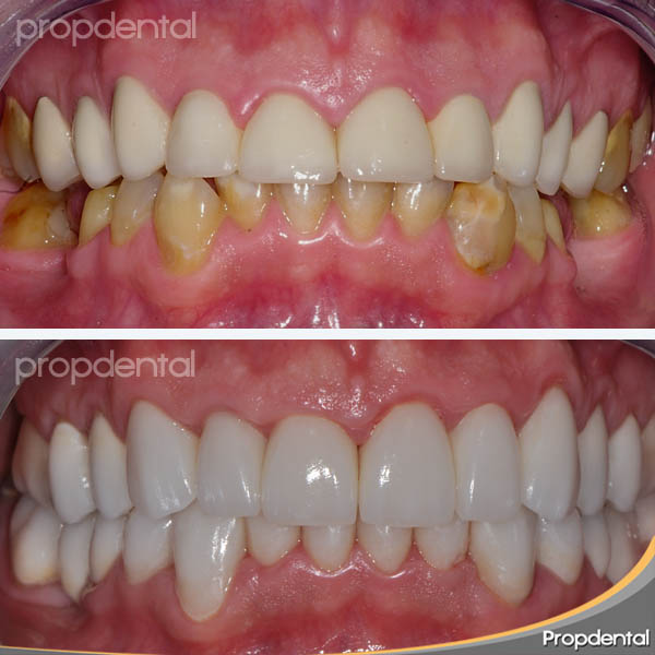 antes y después del caso clínico de estética dental