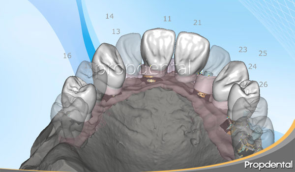 cad cam prótesis sobre implantes dentales