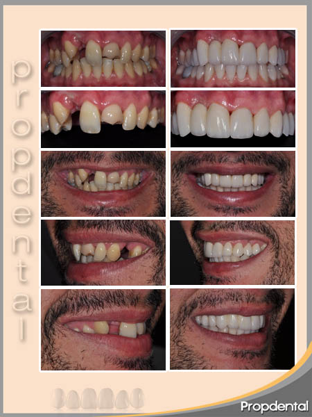 caso clínico de coronas dentales