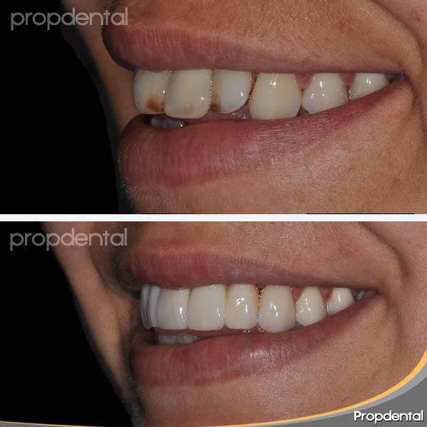 Diferencias entre las coronas de zirconio y de 100% porcelana – Estudi  Dental Barcelona