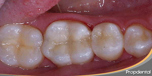 reconstrucción dental de composite