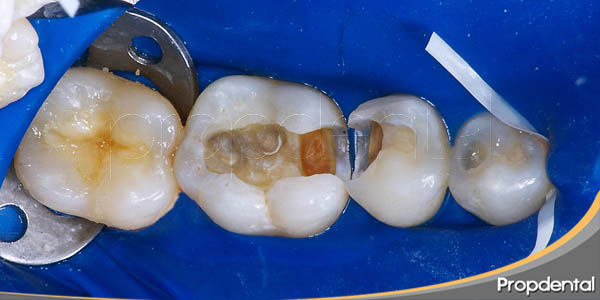 Restaurarea dentară