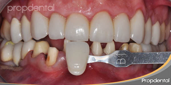 toma de color dientes inferiores