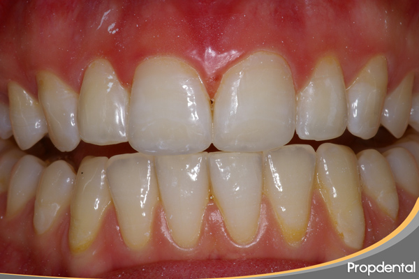 alargamiento bordes incisales