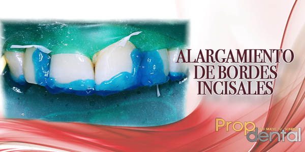 alargamiento de bordes incisales