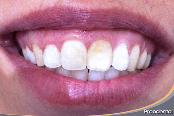 antes de la gingivectomia