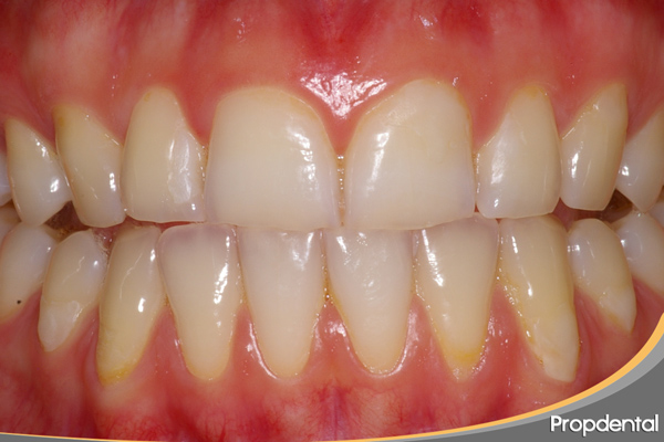 bordes incisales desgastados