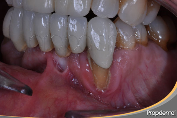 causas de la periodontitis